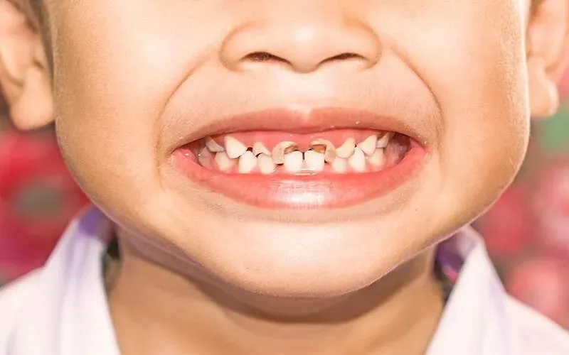 phòng tránh sâu răng ở trẻ