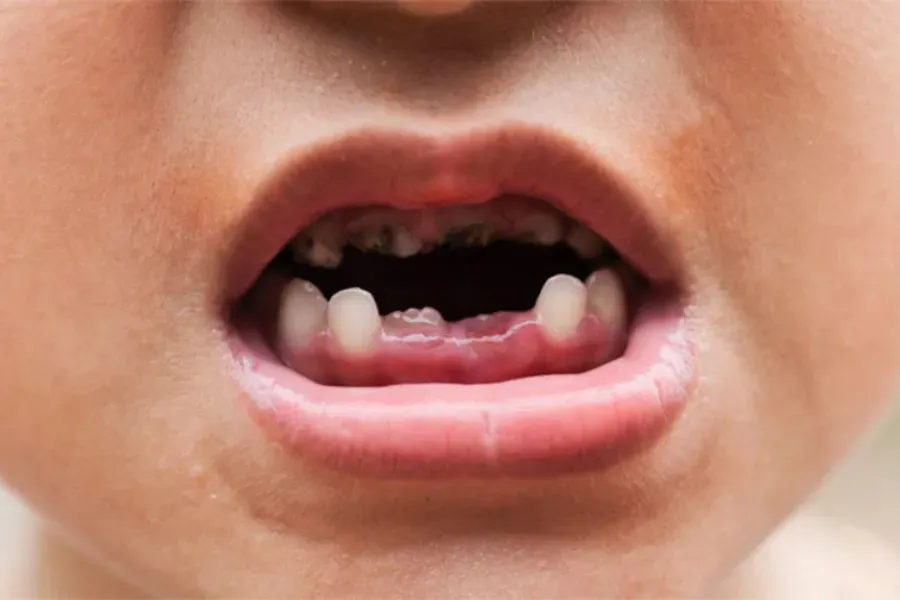 Sâu răng ở trẻ em 