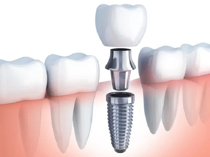 Viêm quanh implant: cơ chế, phòng ngừa, điều trị