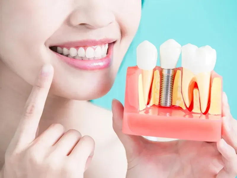 Các Biến Chứng Implant Nha Khoa: Phần 1 – Tổng Quan Thành Công Và Thất Bại