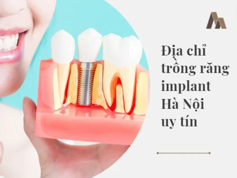 Quy trình implant số hóa toàn diện