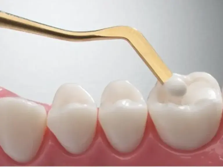 vật liệu trám composite