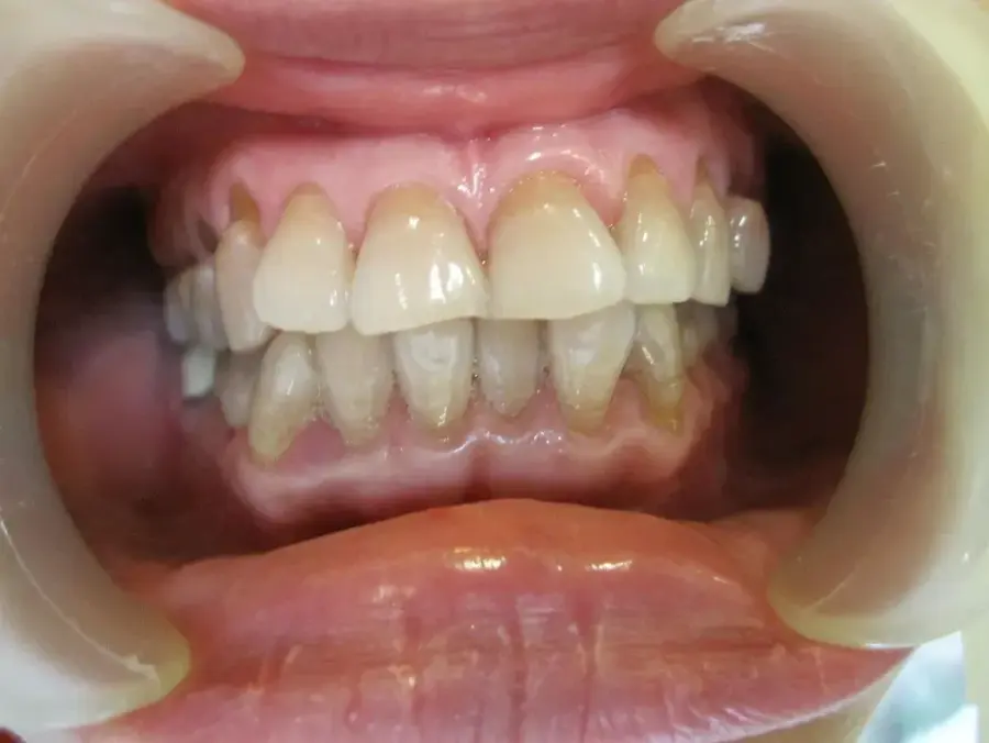 Ảnh hưởng của mòn cổ răng