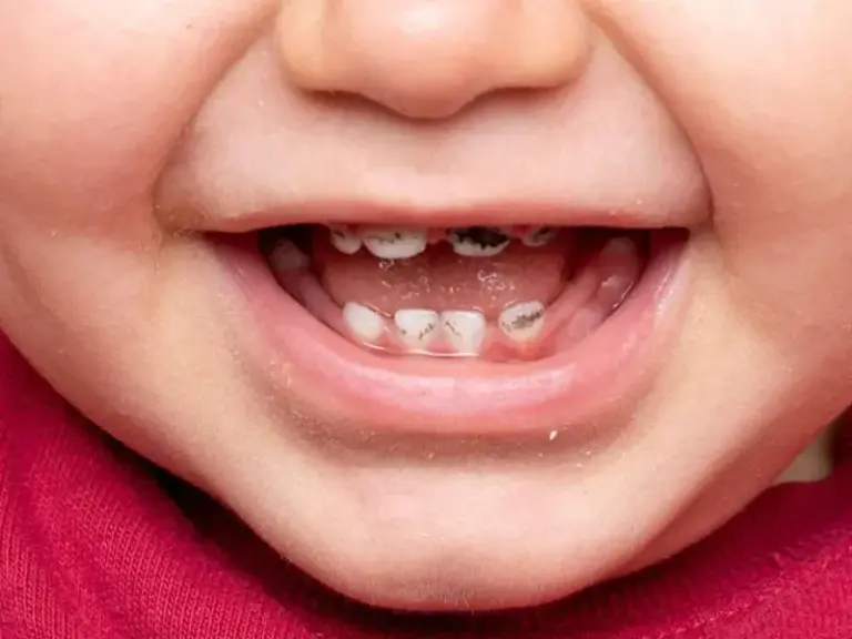 trẻ bị sâu răng