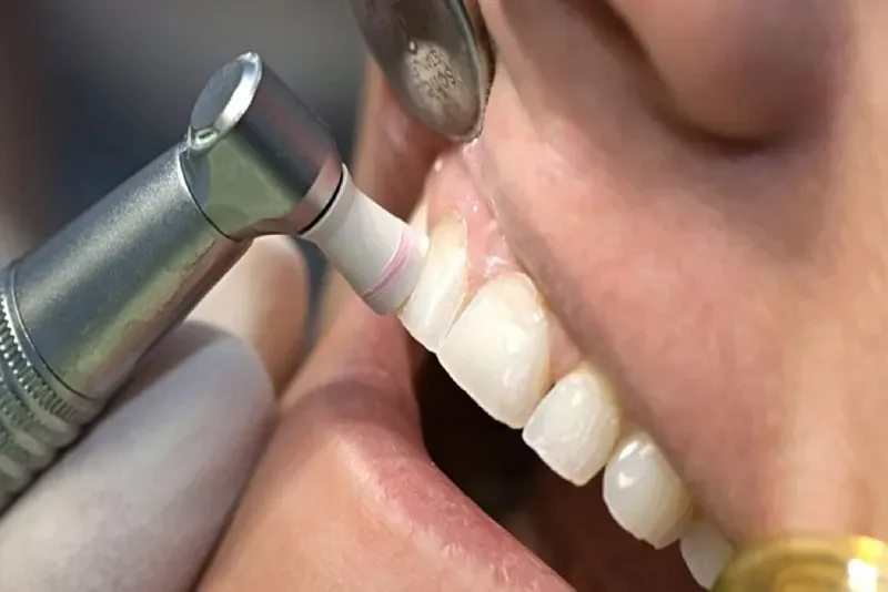 Phương pháp đánh bóng răng