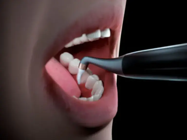 Quy trình thổi cát nha khoa