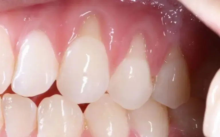 tình trạng mòn cổ răng