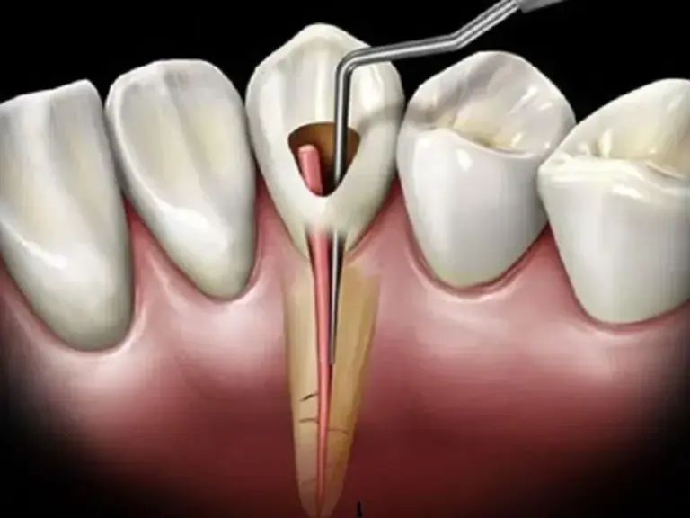 máy rung rửa nội nha