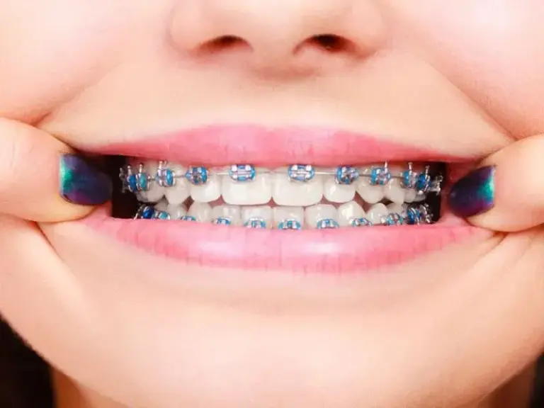 lưu ý cho người niềng