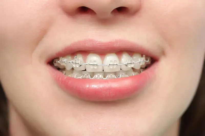 phương pháp niềng răng