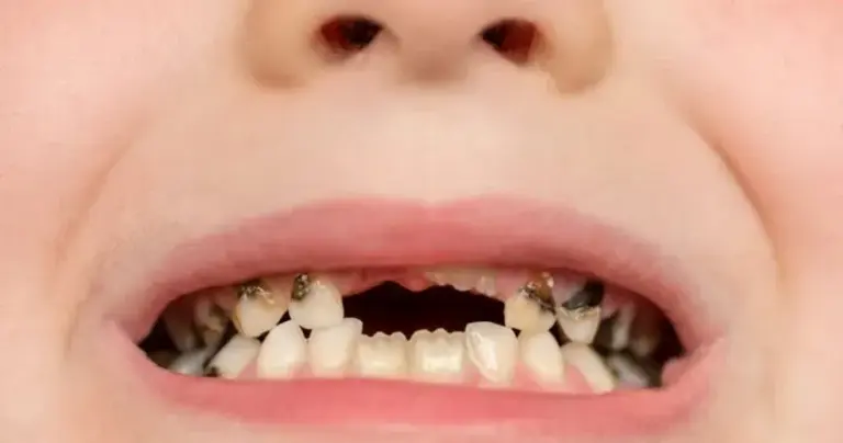 trẻ bị sâu răng sữa