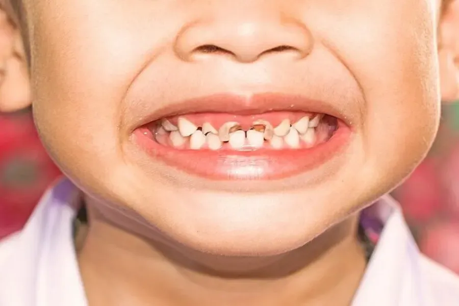 sâu răng sữa ở trẻ