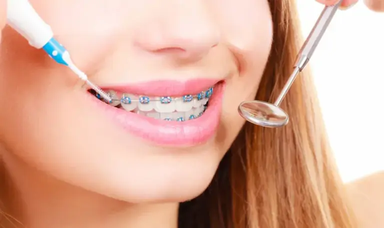 vệ sinh răng cho người niềng