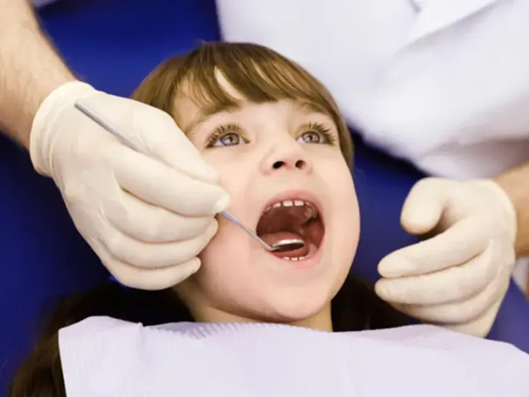 sâu răng sữa ở trẻ