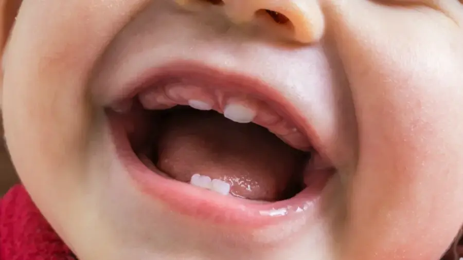 Răng sữa của trẻ
