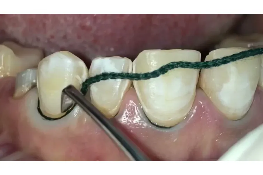 điều trị mòn cổ răng