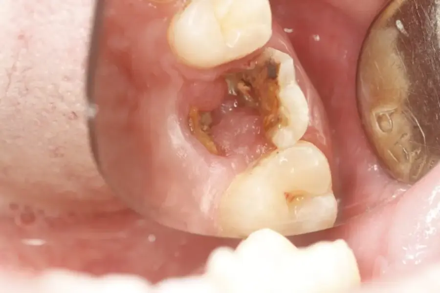 bọc răng sứ khi sâu răngbọc răng sứ khi sâu răng 