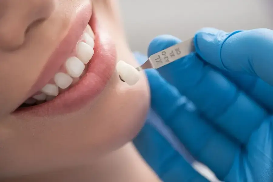 bọc răng sứ khi sâu răng
