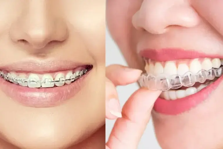 niềng răng trong suốt