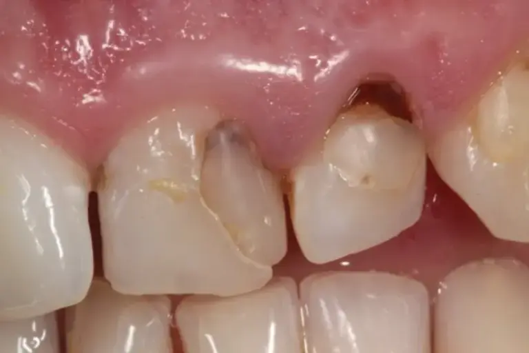 trám phục hồi mòn cổ răng