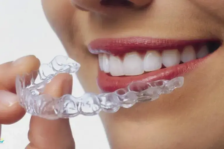 niềng khay trong suốt