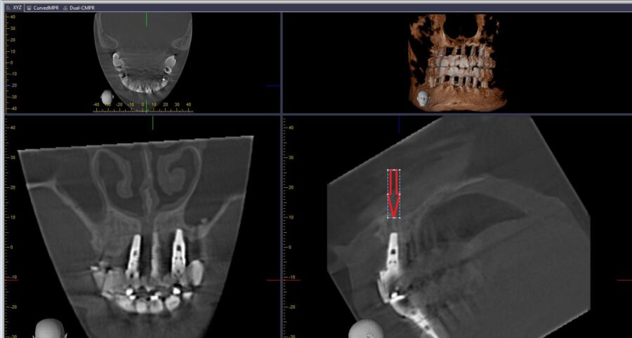 Học Đọc Giải Phẫu Phim X-quang Quanh Chóp: Phần 4
