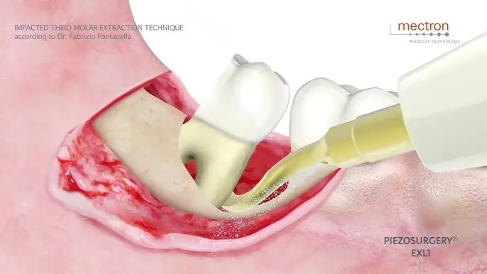 máy phẫu thuật siêu âm, Công ty Anh &amp; Em | J. Morita Việt Nam