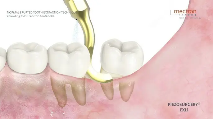 máy phẫu thuật siêu âm, Công ty Anh &amp; Em | J. Morita Việt Nam