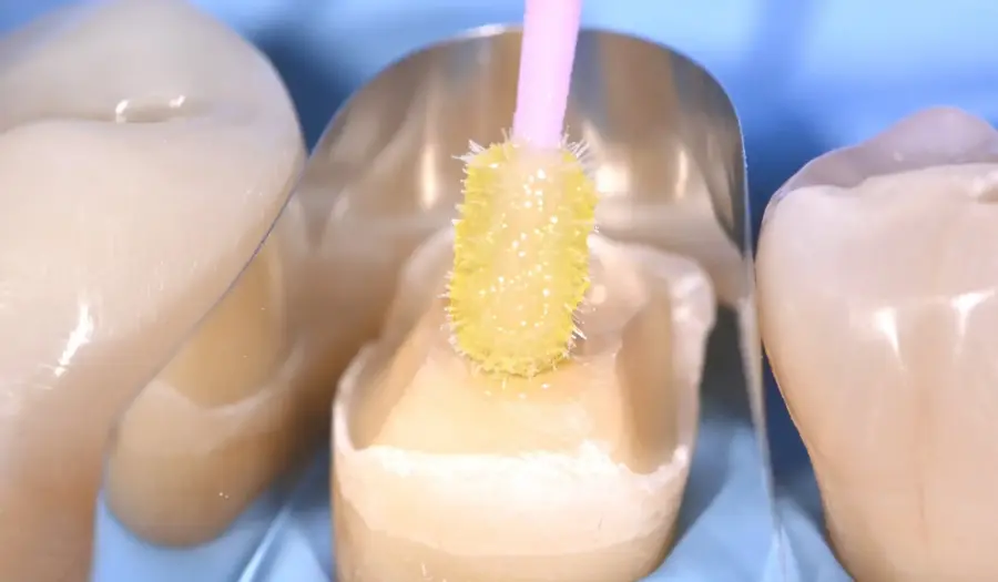 kỹ thuật bít kín ống ngà