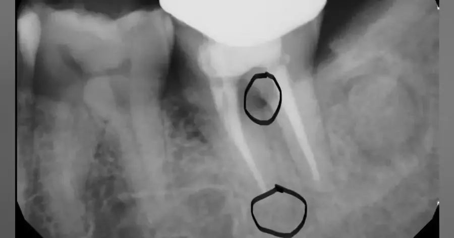 Hơn 60% c&aacute;c ca thất bại nội nha l&agrave; do thiếu sự k&iacute;n kh&iacute;t ở v&ugrave;ng ch&oacute;p hoặc r&ograve; rỉ vi kẽ (microleakage)