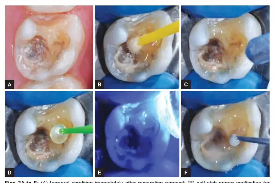 phục h&igrave;nh gi&aacute;n tiếp