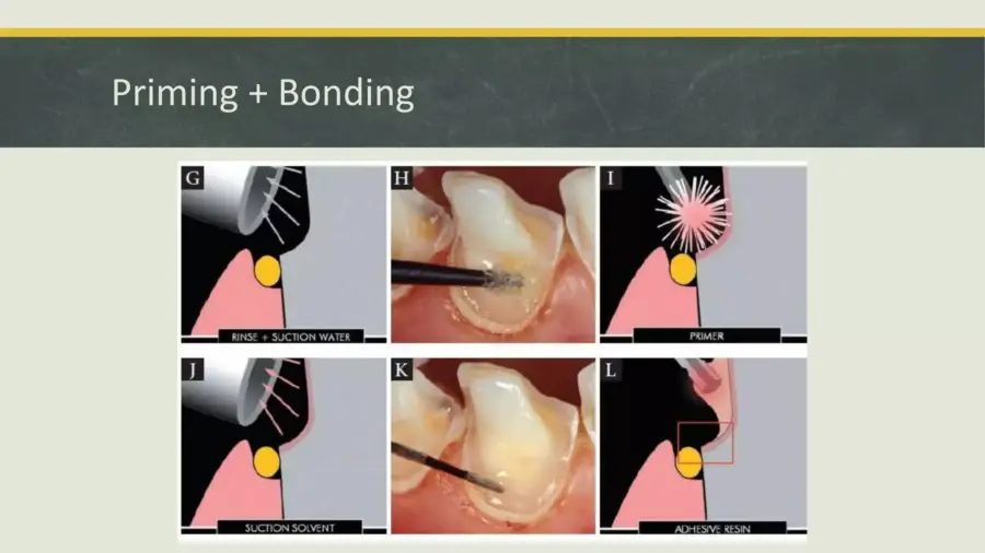 kỹ thuật d&aacute;n ng&agrave; tức th&igrave;, C&ocirc;ng ty Anh &amp; Em | J. Morita Việt Nam