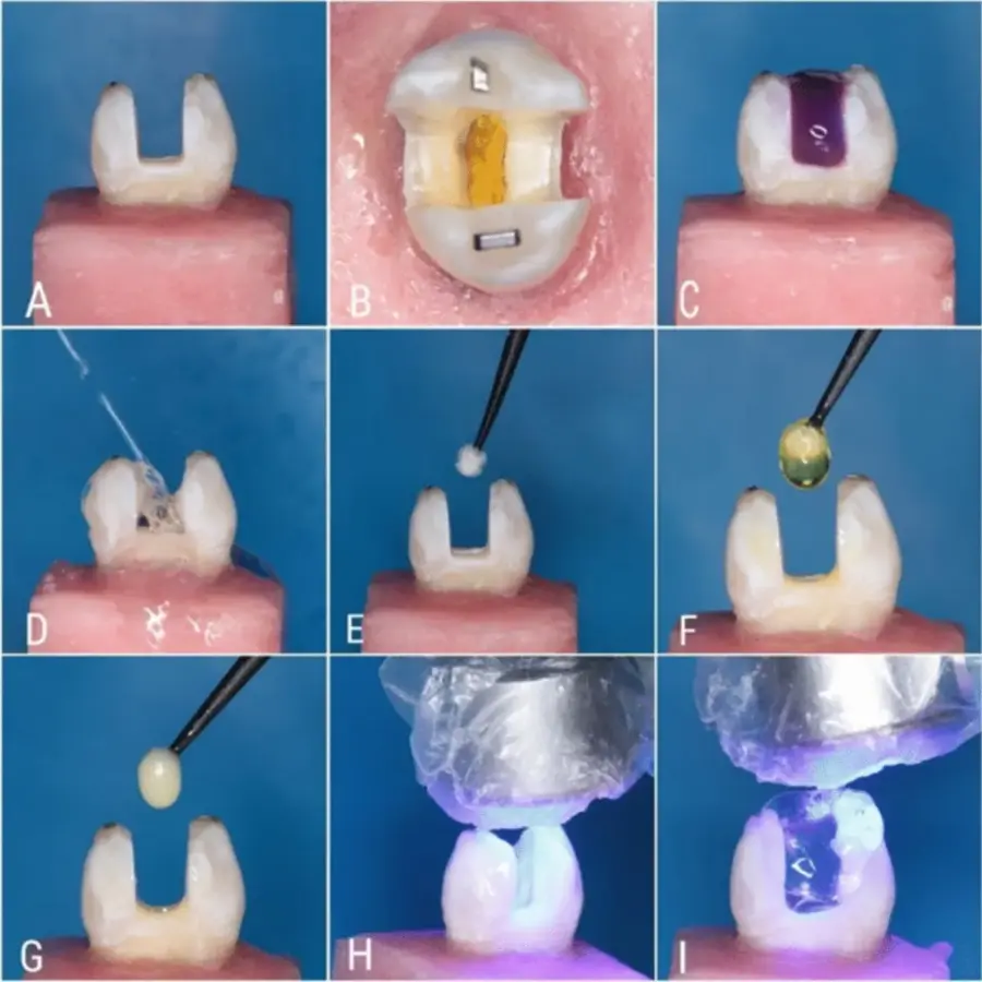 Immediate Dentin Sealing &ndash; IDS