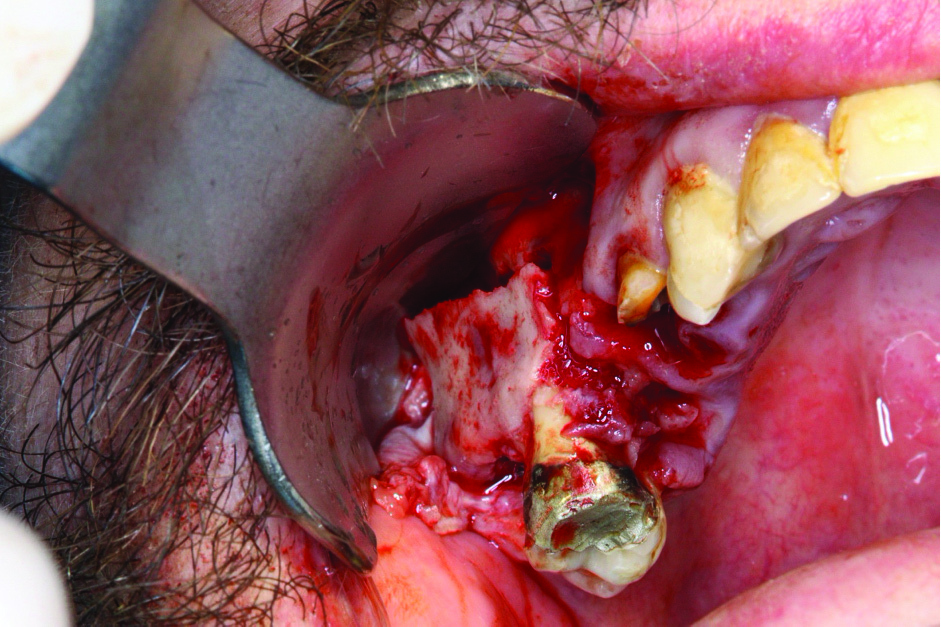 Hình 1: Gãy lồng củ xương hàm trên bên phải