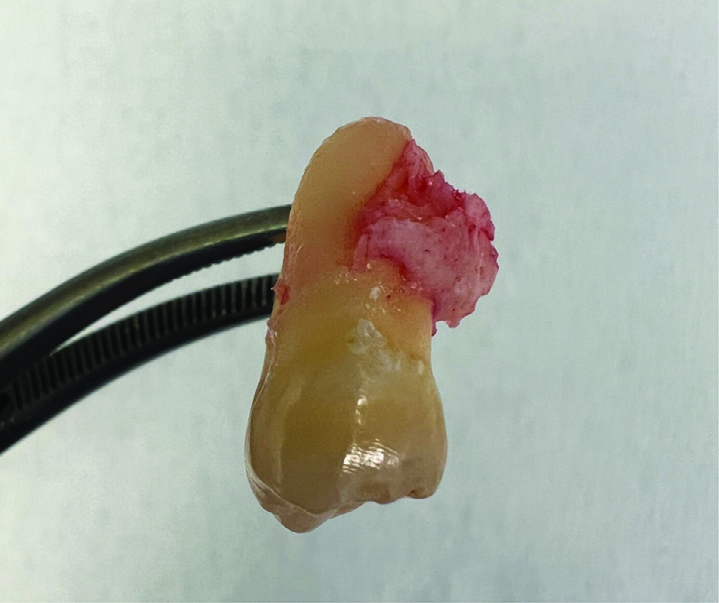 Hình 2: Gãy lồng củ UL8