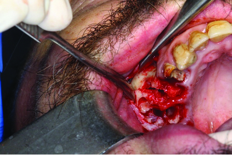 Hình 4A: Vạt niêm-cốt mạc