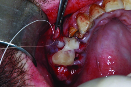 Hình 4B: Bone wax và PRGF