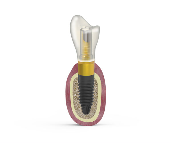 BTI short & extra-short implant - giải pháp implant siêu ngắn cho ca tiêu xương