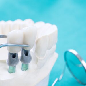 Xử lý bề mặt răng trong gắn kết phục hình sứ: quy trình lâm sàng - How to Clean Care For a Dental Bridge Hero