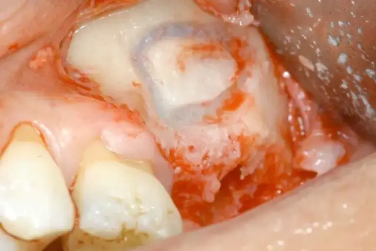 giai-ma-nguyen-ly-cat-chon-loc-selective-cut-vi-sao-piezosurgery-khong-lam-rach-mang-xoang-5