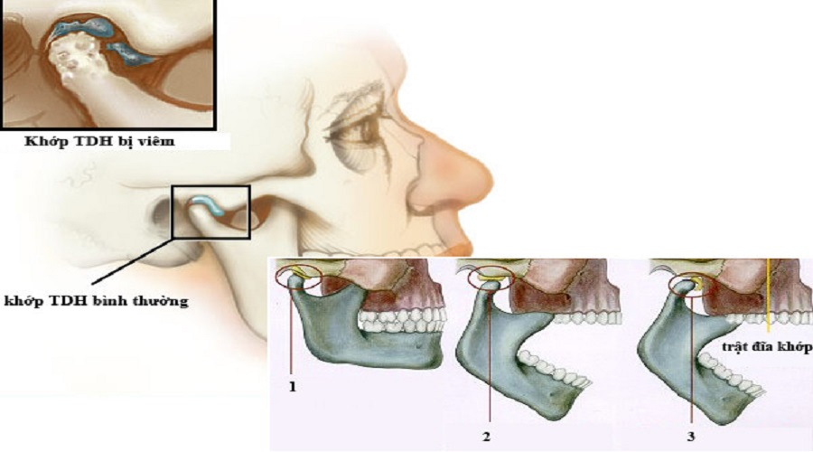 Mất răng hàm lớn ảnh hưởng thế nào đến khớp thái dương hàm (TMJ)? Tìm hiểu nguyên nhân, hệ lụy và giải pháp khắc phục tình trạng rối loạn khớp thái dương hàm ngay.