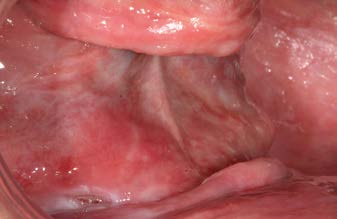 Biểu đồ Kaplan-Meier về tỷ lệ sống sót của Implant ngắn 6.5mm BTI