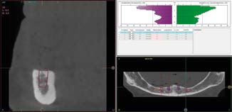 CBCT mô phỏng Implant ngắn 6.5mm BTI