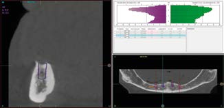 Đánh giá mặt cắt CBCT cho tiêu xương dọc