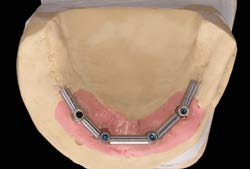 Phục hình trên Implant ngắn 6.5mm BTI