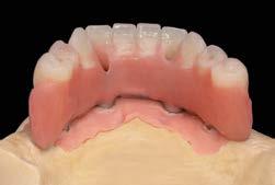 Hình ảnh lâm sàng phục hình trên Implant ngắn 6.5mm