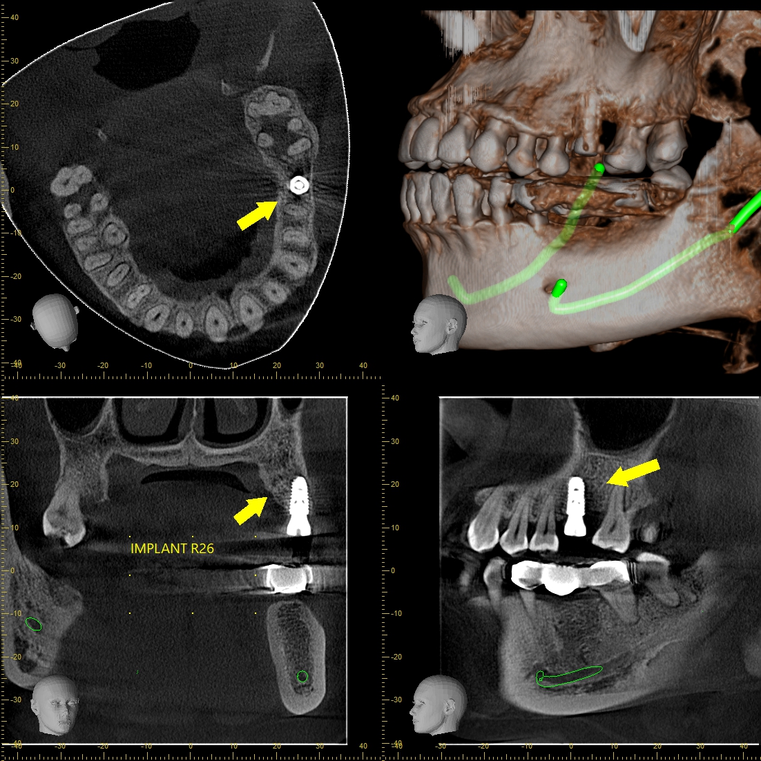 Lập kế hoạch Implant chuyên sâu với hình ảnh CBCT