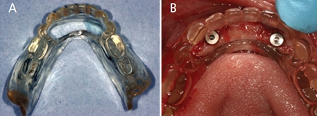 Máng hướng dẫn phẫu thuật: Tối ưu hóa độ chính xác từ thiết kế ảo đến thực tế lâm sàng