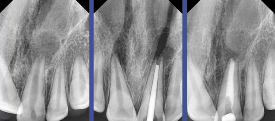 ứng dụng của vật liệu sinh học BGmulti trong điều trị nội nha