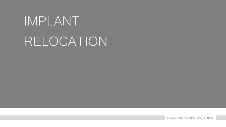 Kỹ thuật Di dời Implant (Implant Relocation) với Mectron Piezosurgery